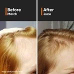 Suero para el crecimiento del cabello Densidad capilar 18%, 30 ml, Minimalista