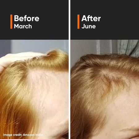 Suero para el crecimiento del cabello Densidad capilar 18%, 30 ml, Minimalista