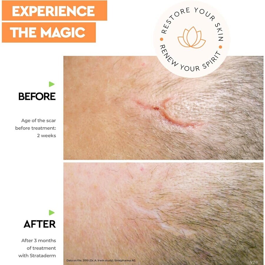Strataderm Scar Treatment Gel, 20 g, Meditrina Pharmaceuticals
