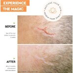 Strataderm Scar Treatment Gel, 20 g, Meditrina Pharmaceuticals Strataderm Scar Treatment Gel, 20 g, Meditrina Pharmaceuticals