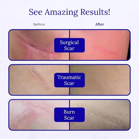Gel de silicone RejuvaSil, 30 ml, Scar Heal