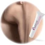Sutricon, Silikon Gel für Narben, 15 ml