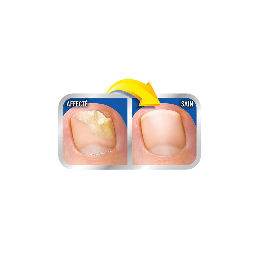 Scholl 2in1 Nagelpilzlösung 3,8 ml Applikator + 5 Feilen