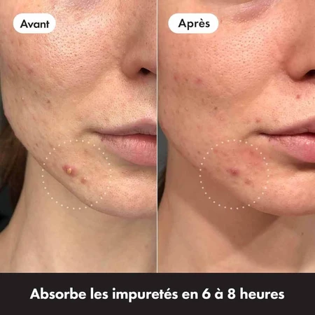Hero Mighty Patch anti-acne nachtpleisters l'Original x24