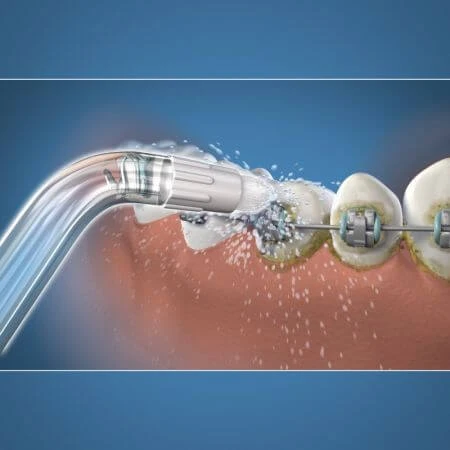 Cabezales ortodónticos para enjuague bucal, 2 piezas, OD-100, Waterpik