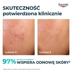Eucerin DermoPure Clinical Peeling 10, peelende und glättende Behandlung für zu Akne neigende Haut, 40 ml