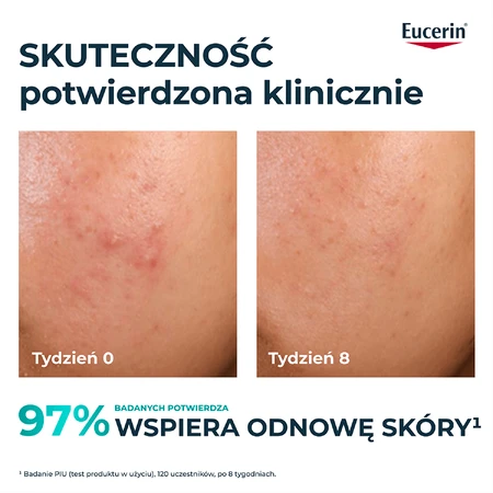 Eucerin DermoPure Clinical Peeling 10, peelende und glättende Behandlung für zu Akne neigende Haut, 40 ml