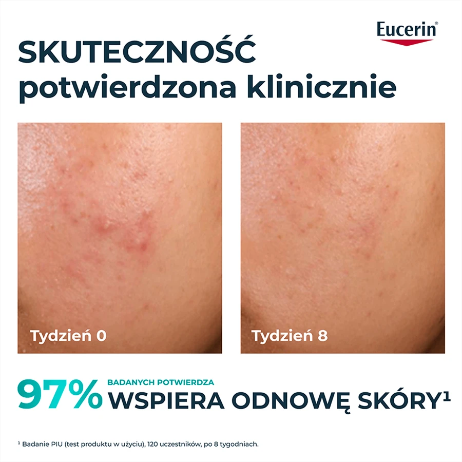Eucerin DermoPure Clinical Peeling 10, peelende und glättende Behandlung für zu Akne neigende Haut, 40 ml