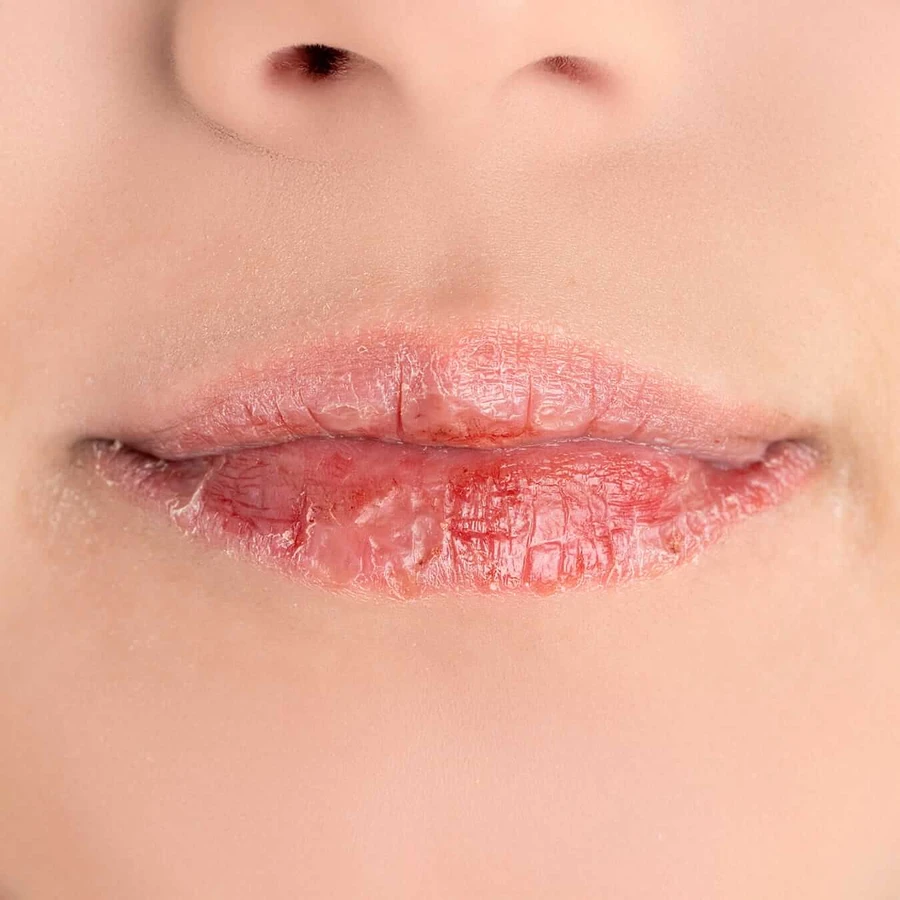 Allergic, lip balm, 15 ml
