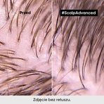 L'Oreal Scalp Advanced, reinigende shampoo, 1,5 l