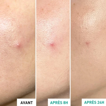 Erborian Centella SOS-pleister – Behandeling tegen huidonzuiverheden 9 ml