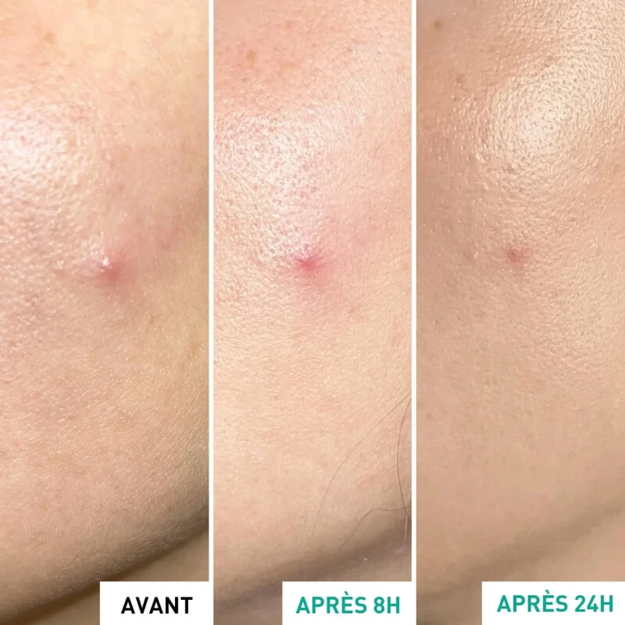 Erborian Centella SOS-pleister – Behandeling tegen huidonzuiverheden 9 ml