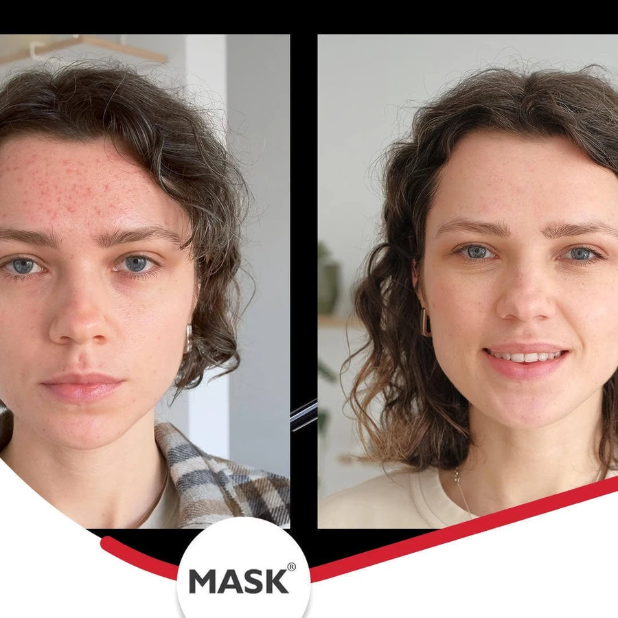 Mask Plus Acne Gel, 2x30 ml, Solartium: ceny i cechy